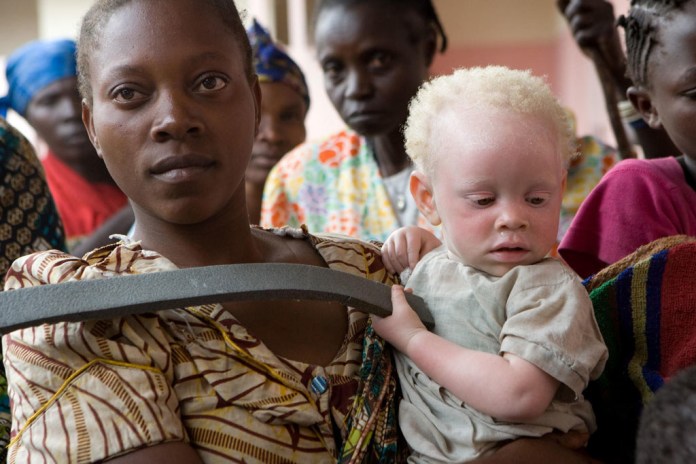 Les meurtres d’albinos ont augmenté pendant la pandémie post thumbnail image